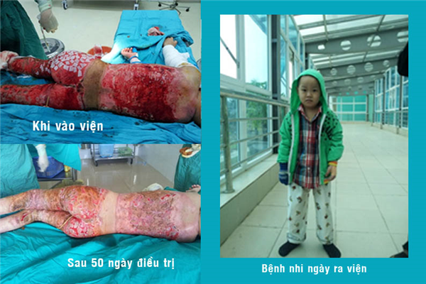 Điều trị thành công bệnh nhân nhi bỏng nặng 56% diện tích cơ thể (53% diện tích bỏng sâu), biến chứng sốc nhược, nhiễm khuẩn huyết